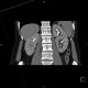 Duplication of collecting system of kidney, ureter fissus: CT - Computed tomography